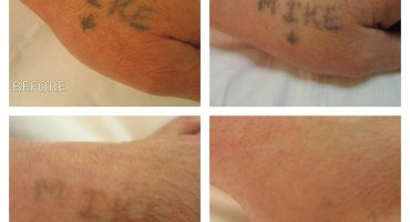 Before and after removing amateur ink, Gone in only 5 treatments!